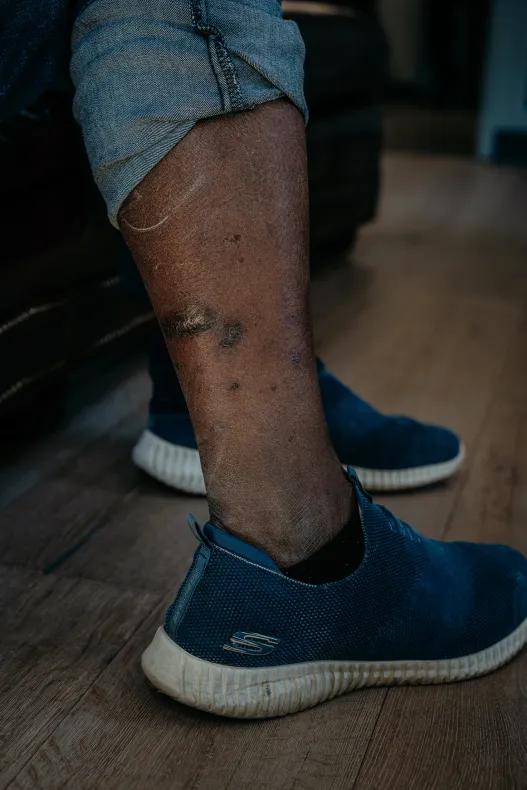 A man’s leg with his pant leg rolled up. Above his ankle, there are scars.